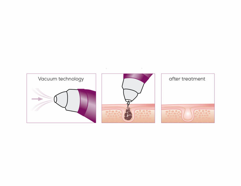 beurer power deep pore cleanser fc 40